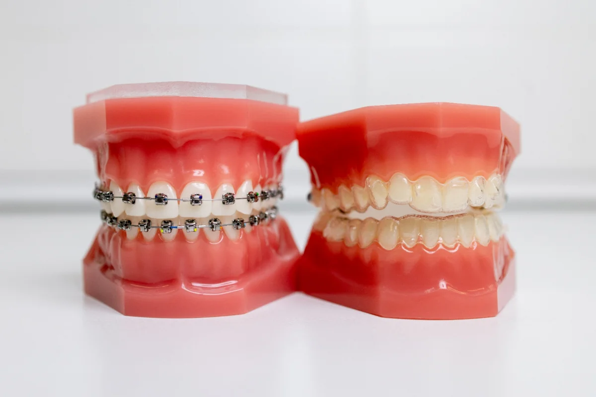 Eating with Invisalign: Navigating a Braces-Free Diet During Treatment