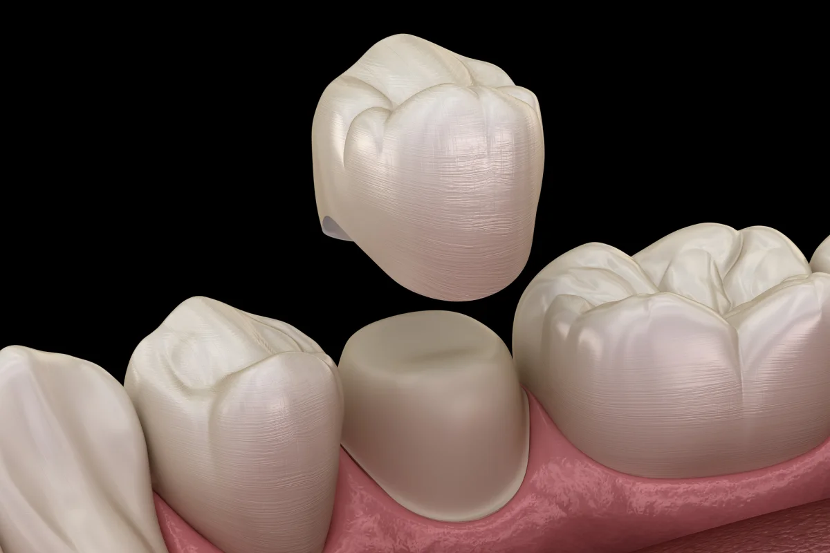 The Art of Tooth Restoration: Crafting Natural-Looking Crowns