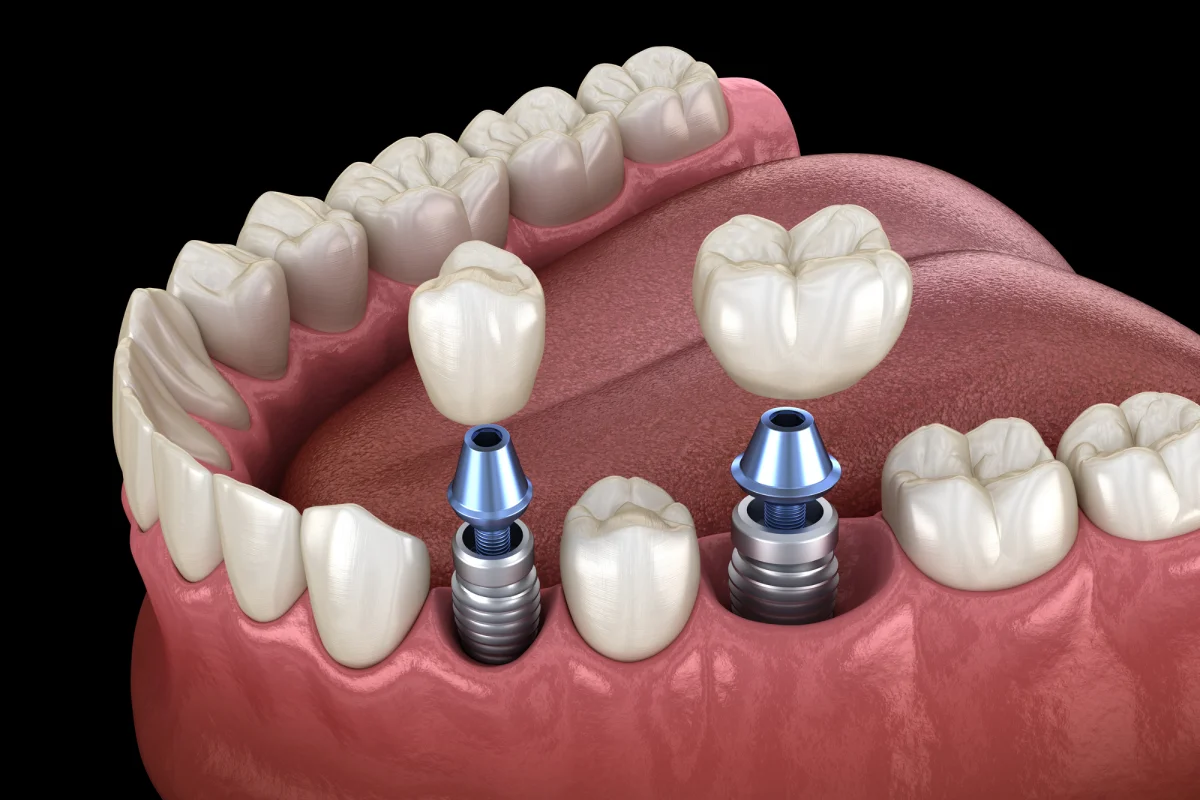 The Impact of Dental Implants on Your Overall Health