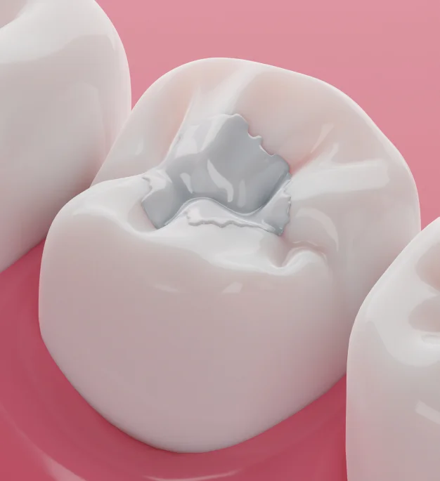 
Repair Cavities Without Sacrificing Your Smile