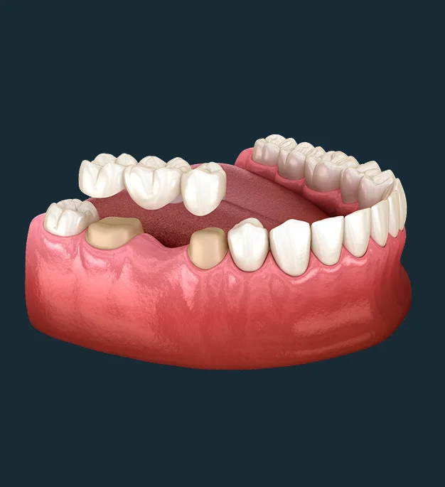 Fill the Gap in Your Smile with a Natural-Looking Dental Bridge