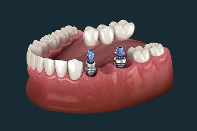 Implant-Supported Bridges
