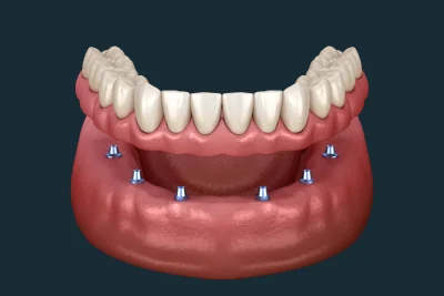 Implant-Supported Dentures
