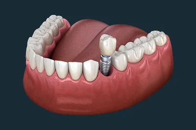 Single-Tooth Implants
