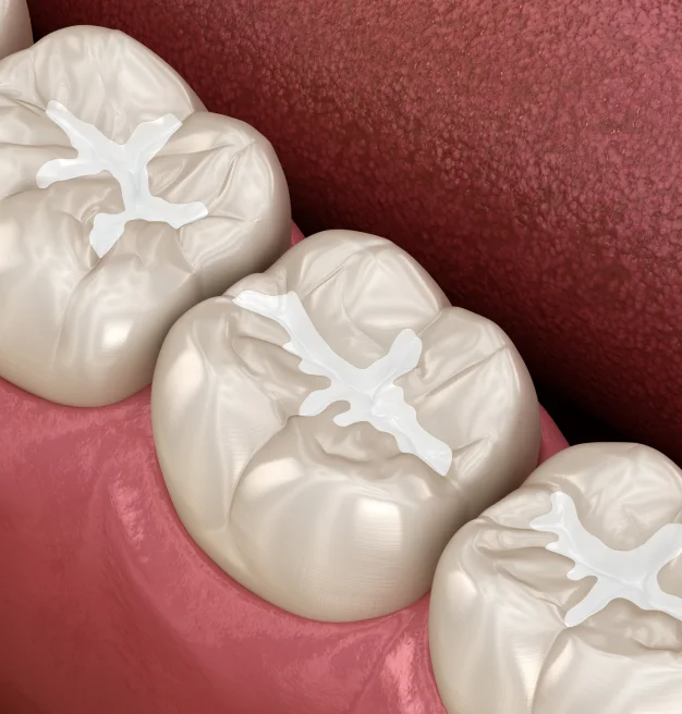Long-Lasting Cavity Protection for Children, Teens, and Adults