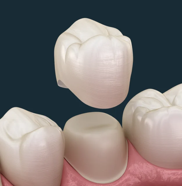 A Custom Ceramic Crown in Just One Appointment
